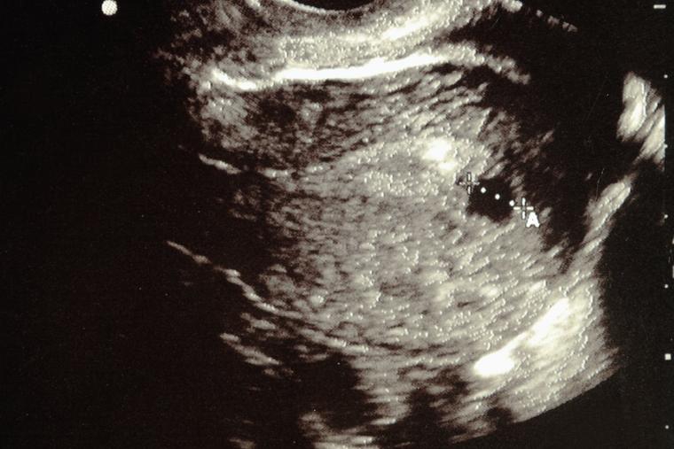Ultrasound shows an unborn child in the sixth week of pregnancy.